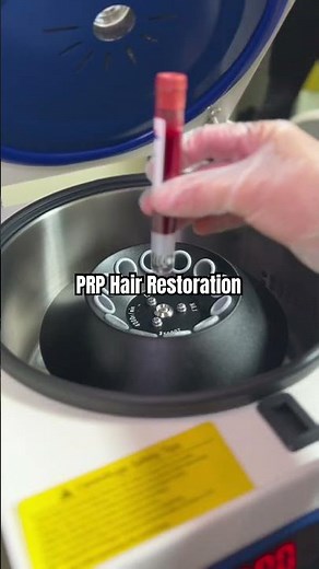 PRP Hair Thickening #prp #prphairtreatment #hairthickness #hairthickening #mansculpt #ytshorts