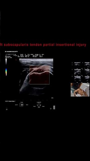 lesione parziale inserzionale del tendine sottoscapolare sinistro