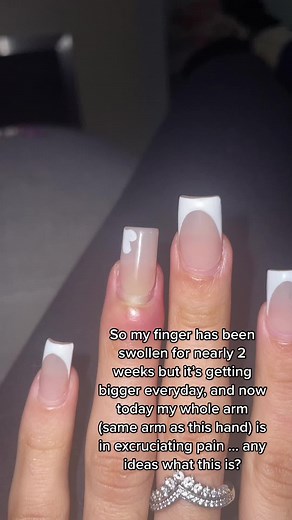 Home Remedies for Infected Finger Swelling