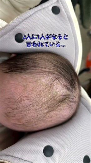 Effortlessly Remove Baby Scalp Scales!? The "Ultimate Infant Seborrheic Dermatitis Softening Hack."