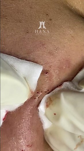 Big Cystic Acne Blackheads Extraction Blackheads & Milia, Whiteheads Removal Pimple Popping #shorts