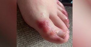 COVID toes: Mysterious rash can affect feet in patients with coronavirus