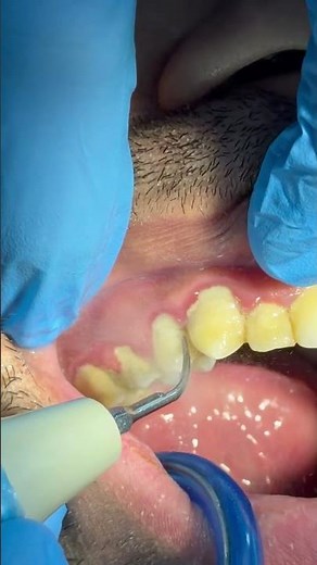 Professional Teeth Scaling | Precision Dental Cleaning