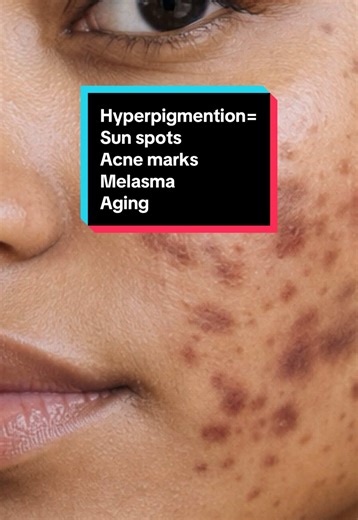 Effective Solutions for Hyperpigmentation Treatment