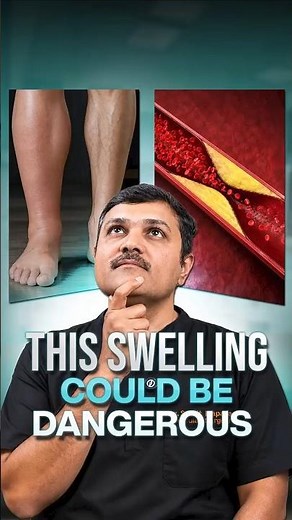 One Leg Swollen? ⚠️ This Could Save Your Life