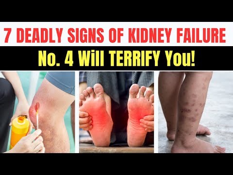 7 DEADLY Signs of Kidney Failure in Your Feet! No. 4 Will TERRIFY You!