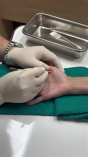 นิ้วล็อคระยะ 2 ฉีดยาและทำ percutaneous release หายปวด หายล็อค รอดู 3 เดือนจะเป็นซ้ำอีกมั้ย #นิ้วล็อค #ฉีดยา #ปวดนิ้ว #สะกิดนิ้วล็อค #ไม่ผ่าตัด #หมอกระดูก #หมอออร์โธ #หมอณัฐธนนท์ #ข้อดีใกล้ฉัน #หมอกระดูกใกล้ฉัน #ดีทัชสหคลินิก #