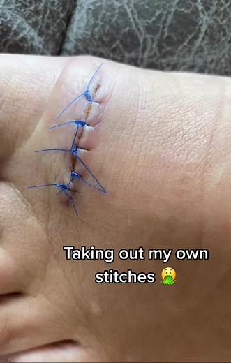 Removing Stitches Safely at Home