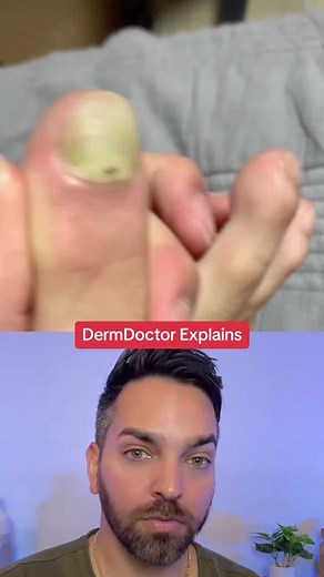 The grippers #dermatologist #toenailfungus | Dermatologist