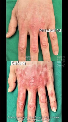 ❌Korean scar treatment technology is this incredible❌