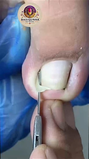 190K views · 1.1K reactions | Smart Health Tips for Foot and Nail Comfort For Comfortable Movement #SimpleNailCare #ToenailRoutine #CleanNailsDaily #HealthyNails | Basiquinha | Facebook