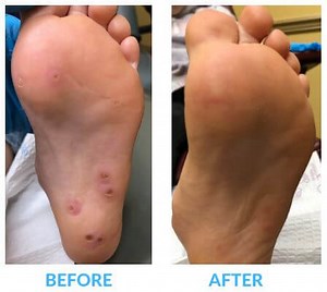 Eliminate Your Stubborn Plantar Warts for Good With Swift