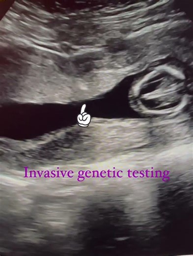 What happens if my screening test for genetic problems comes back high risk? We will offer you