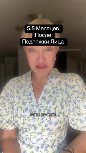 5.5 Months After Face Lift: Results Explained