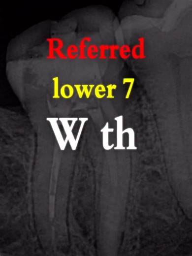 Blockage and Ledges Management in Endodontics