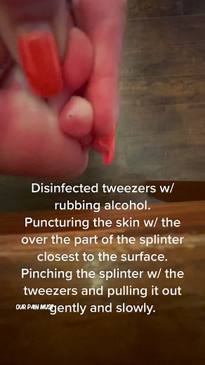 Effective Splinter Removal Techniques with Tweezers