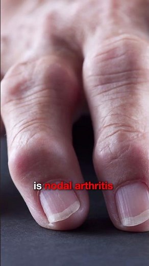 Nodal Finger Arthritis Explained