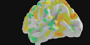 Mayo Clinic researchers define a new memory loss syndrome often mistaken for Alzheimer’s