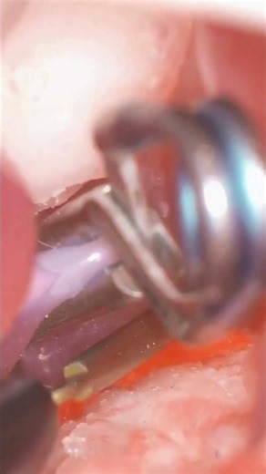 Mastering Aneurysm Clipping with Advanced Simulation | Dr Ashutosh | SurgeonsLab