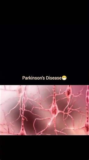 Haath Kaapna Normal Nahi! 😨 Parkinson’s Disease Ka Early Warning Sign? (Hindi)