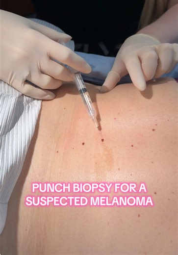 Another punch biopsy... are we surprised?? 🤣 📍Cosmic at Aesthetic and Dermatology Center #dermatology #biopsy #nursepractitioner #medicine #aesthetic