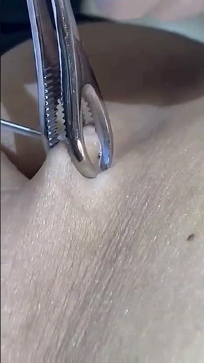 navel piercing| professional needle piercing in mangalore | bellybutton piercing