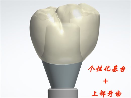 3shape软件 个性化基台 上部冠同时设计 仅供参考