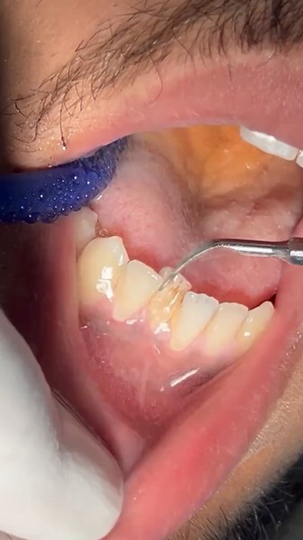Effective Tartar and Calculus Removal by Dentists