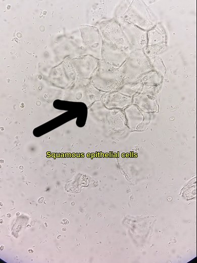 Understanding Hematuria: Bacteria and Epithelial Cells in Urine