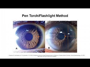 How Do You Clinically Assess the Anterior Chamber Depth?