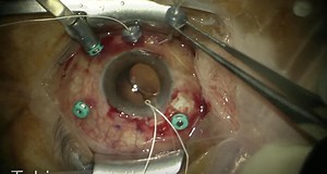 Scleral Fixation of an IOL Using Gore-Tex - Eyetube