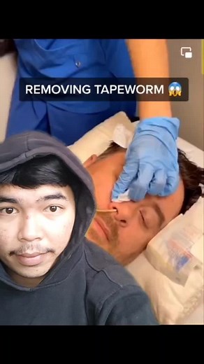 Removing Tapeworm: Medical Procedure Explained