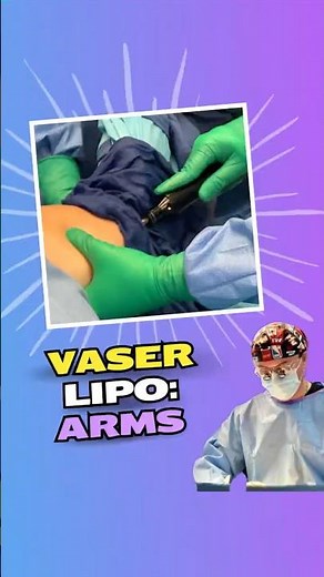 VASER Liposuction: Underarm | Target Stubborn Fat for a Sleeker, Defined Contour