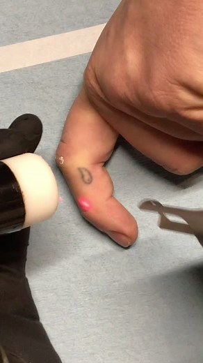 ClearLase Tattoo Removal on TikTok