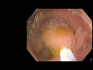 Underwater EMR of Ascending Colon Polyp