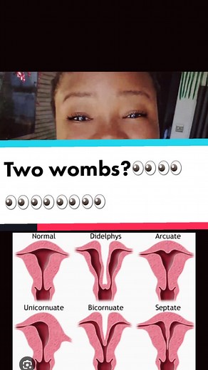 Understanding Uterus Didelphys: Risks and Pregnancy Tips