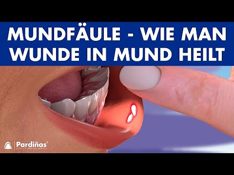 MUNDFÄULE - Wie man Wunde in Mund heilt ©