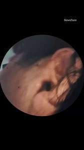 142K views · 626 reactions | Live cockroach pulled from a patient's ear  | The Sun | Facebook