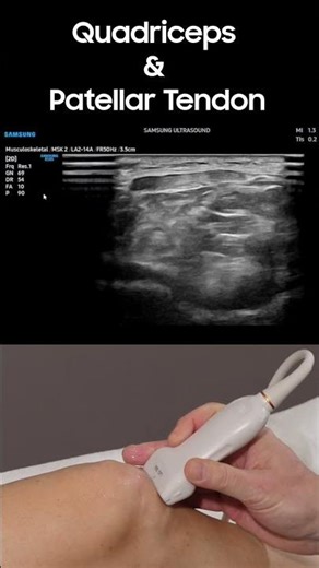 Ultrasound the Quadriceps and Patellar Tendon