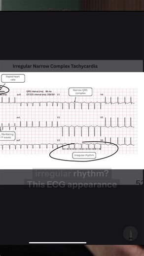 What’s causing this fast heart rate? 🚑 👉 I have more ECG support tools in my bio