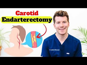 Doctor explains Carotid Endarterectomy | Procedure, benefits, risks and recovery