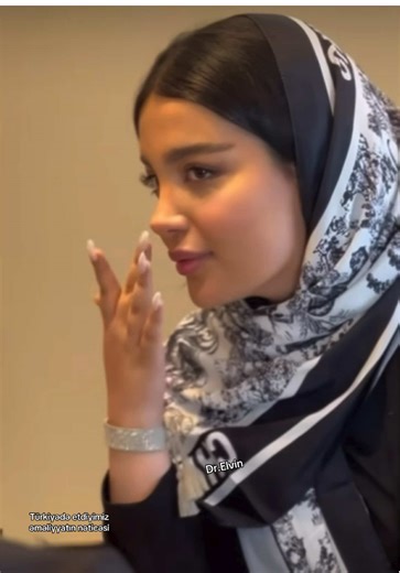 #rinoplastika #drelvin #burunemeliyyati #kesfet #bakuazerbaijan