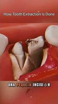 The Real Process of Tooth Extraction. #shorts