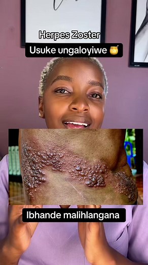 What causes ibhande (herpes zoster)? It’s a virus that we usually contract in childhood, the same one that causes Chicken Pox. #varicellazoster #chickenpox #herpeszoster #drlethukwenama #healtheducationsouthafrica