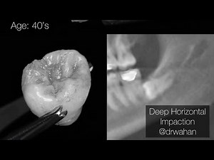 Deep Horizontal Impacted Third Molar Extraction with L-PRF Plug