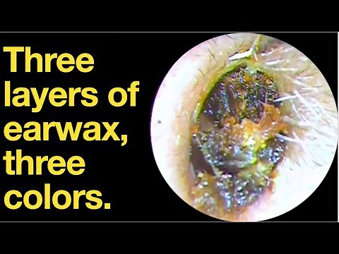 Three layers of earwax, three colors. |ear wax removal | ear cleaning | ASMR | relaxation | relax