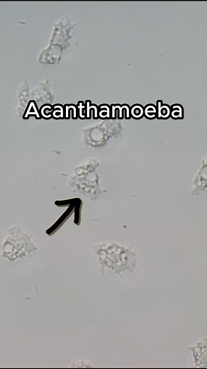 Researchers from UNSW Science and UNSW Medicine & Health are finding out more and more about the Acanthamoeba, a microorganism that can cause the extremely rare but potentially sight-threatening eye infection, Acanthamoeba keratitis (AK). Acanthamoeba, which has been found in seawater in sites across NSW, is particularly worrying for people who wear contact lenses. You can find out more about this unusual microorganism, as well as tips for avoiding AK infection, here: https://www.unsw.edu.au/new