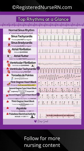ECG Rhythms Made Easy for nursing school students, nurses, and more. Here are some of the top EKG rhythms you'll want to know as a nurse. Some of the top rhythms include: -Normal sinus rhythm -Sinus tachycardia -Atrial fibrillation -Atrial flutter -Ventricular fibrillation -Ventricular tachycardia -Torsades de Pointes -First-degree heart block -Second degree type I heart block -Second degree type II heart block -Third degree heart block -Asystole -Pulseless electrical activity (PEA) #fyp #nursin