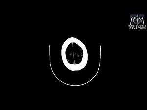 SCANNER CEREBRAL (Traumatisme crânien avec confusion.)