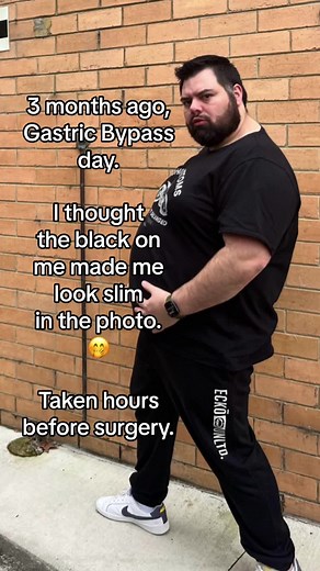 Healthier and Happier Gastric Bypass Journey: Before and After Transformation